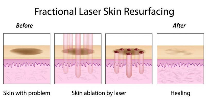 CO2 Laser Medical Skin Care Treatment Product