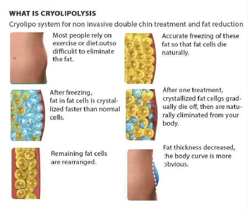 RF Fat Removal Cryolipolysis Liposuction 360 Cryo Slimming Machine