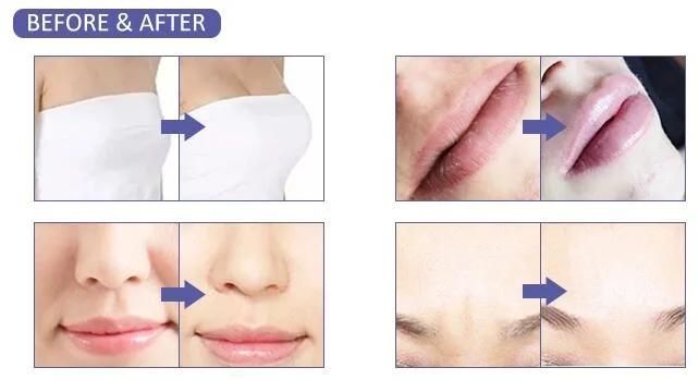 High Pressure Hyaluronic Acid Pen Lip Dermal Filler Injector Lip Filler for Hyaluronic Acid Pen