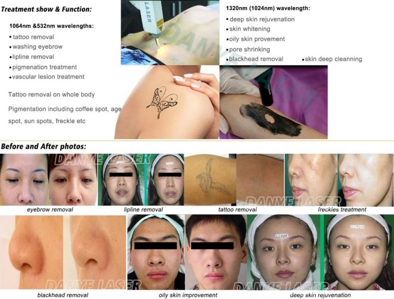 Q Switch ND YAG Laser 532 1320 1064nm Tattoo Removal Carbon Peeling Skin Rejuvenation Handpiece