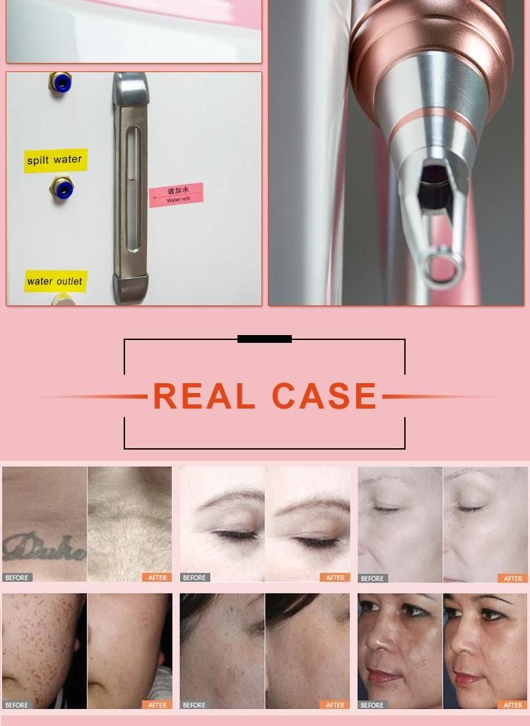 Distributors Wanted Multifunctional Elight RF IPL Tattoo Removal Picosecond Laser Machine