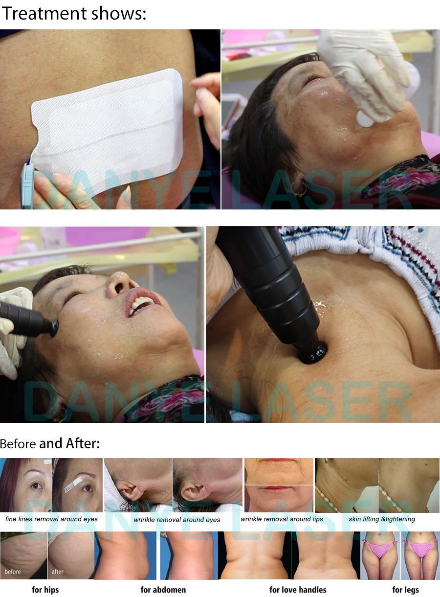Professional Face and Body Radio Frequency Skin Tightening and Stretch Marks Wrinkle Removal Machine