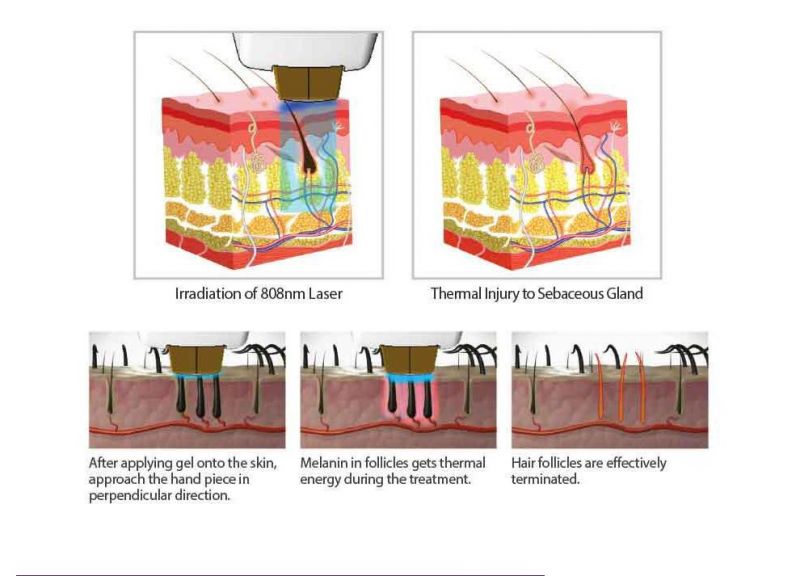 3 Wavelength Diode Laser Hair Removal 755 808 1064 Laser/3 Wave 755nm 808nm 1064nm Diode Laser