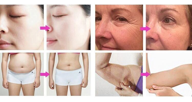 Best Selling RF 40K Cavitation Ultrasound Body Slimming Anti-Wrinkle Machine