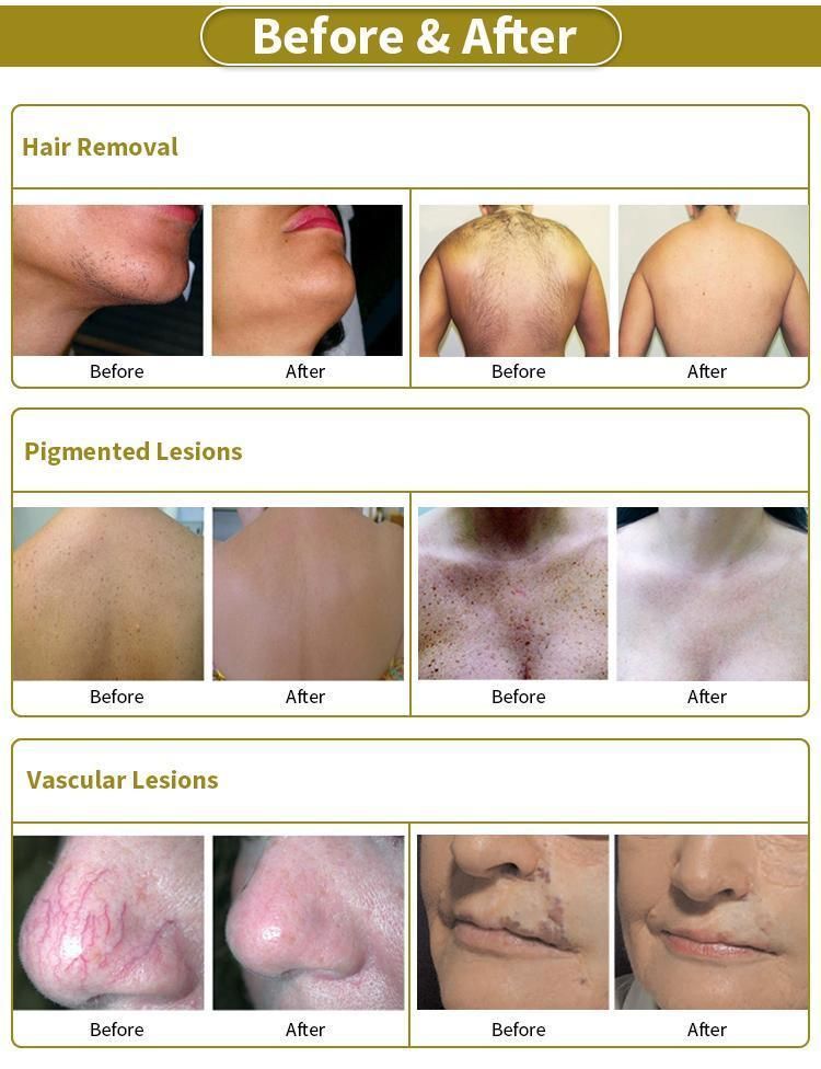 Alexandrite Laser Hair Removal 755 1064nm Long Pulse Laser Hair Removal Vascular Removal