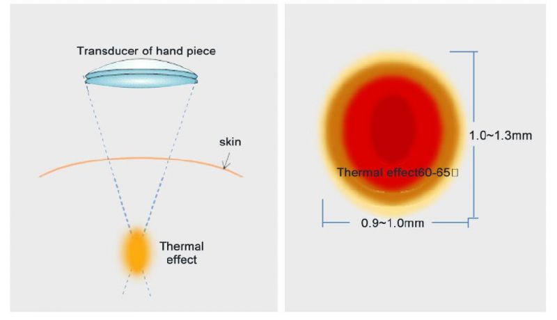 OEM / ODM 4MHz Ultrasonic Face Lift Hyperthermia Therapy Hifu Anti-Aging / Hifu Face Lift Machine