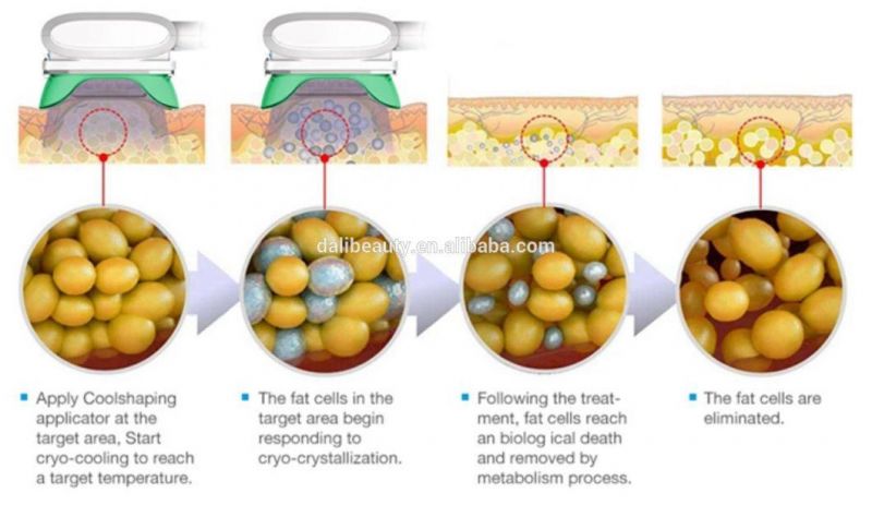 3 Cryo Handles RF Ultrasound Cavitation Cryolipolysis Weight Loss Cryotherapy Beauty Machine