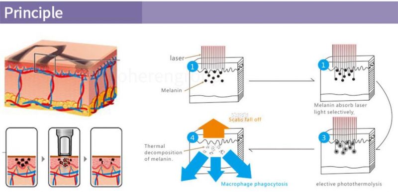 Az Portable Tattoo Removal Machine Picosecond Q-Switch ND: YAG Laser for Carbon Peeeling and Pigment Treatment