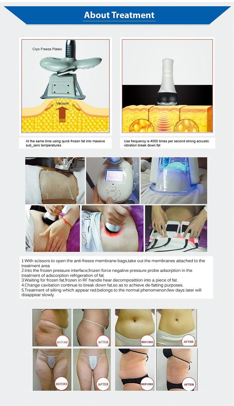 Hot Sale Portable Cryotherapy Cryolipolise Vacuum Cryolipolysis Machine Lipo Laser Cavitation RF