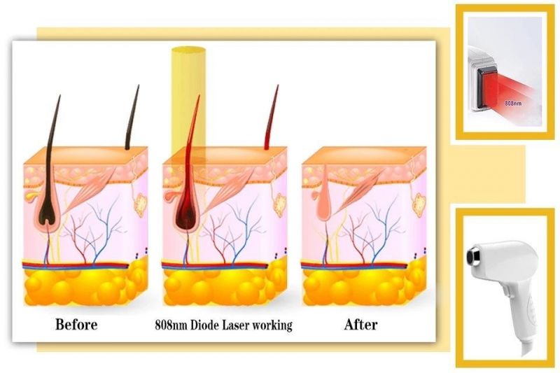 FDA Approved 1200W 3 Wavelength 755 808 1064nm Diode Laser Soprano Ice Laser Hair Removal