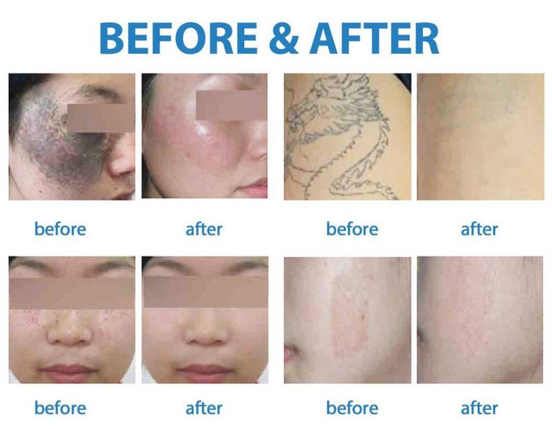 Jo. Medical CE Approved Laser Pigment Therapy Q Switch ND YAG Laser Tattoo Removal Equipment for Professional Doctor and SPA Clinic Use