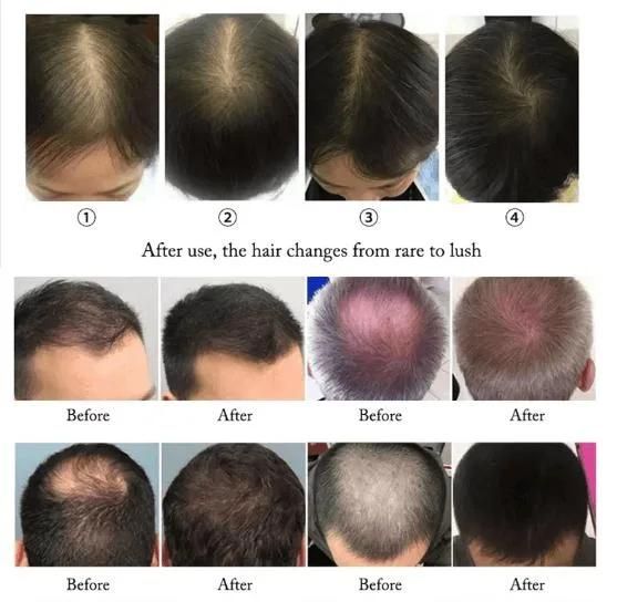 Professional Therapy Machine Hair Growth Machine Laser Hair Growth Machine