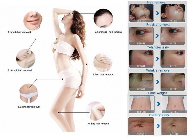 Professional Elight (IPL/RF) Hair Removal with CE, ISO, Sfda