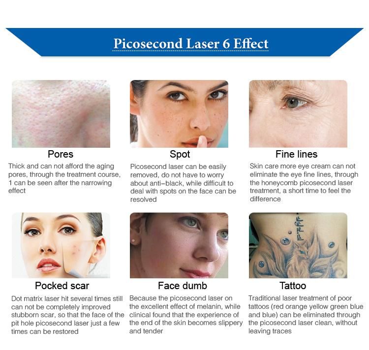 Best Quality Picosecond Laser 1064&755nm&532nm Tattoo Freckle Pigmentation Removal