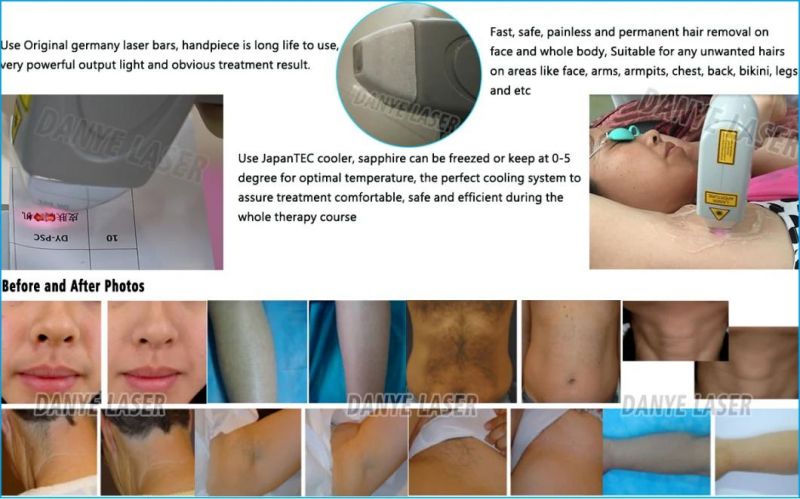 Effective 810nm Depilacin Laser De Diodo Hair Removal for All Skins