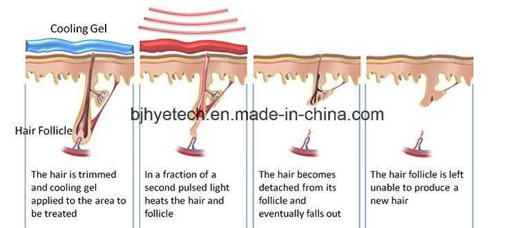 Depilator Laser Diode 808nm Hair Removal Machine Skin Care Diode Laser