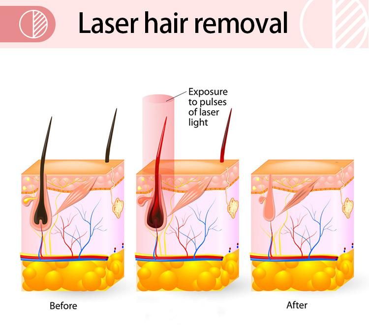 Ce Approved 808 Diode Laser Hair Removal Equipment with Best Functions