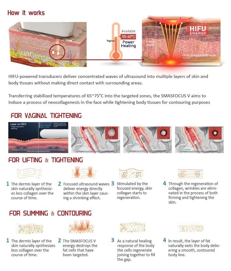 Nubway Newest Products Wrinkle Removal Hifu Proftable