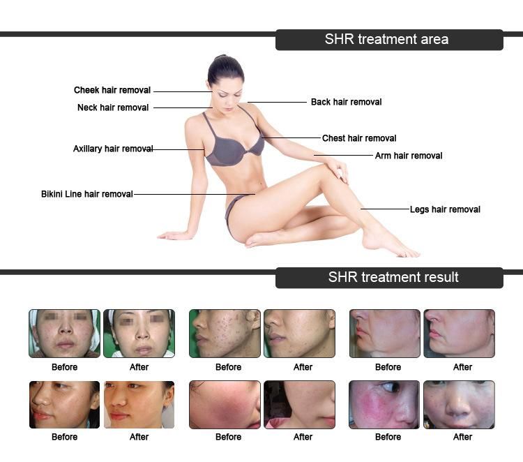 Ce FDA Approved IPL RF Shr Laser Hair Removal Machine/Device