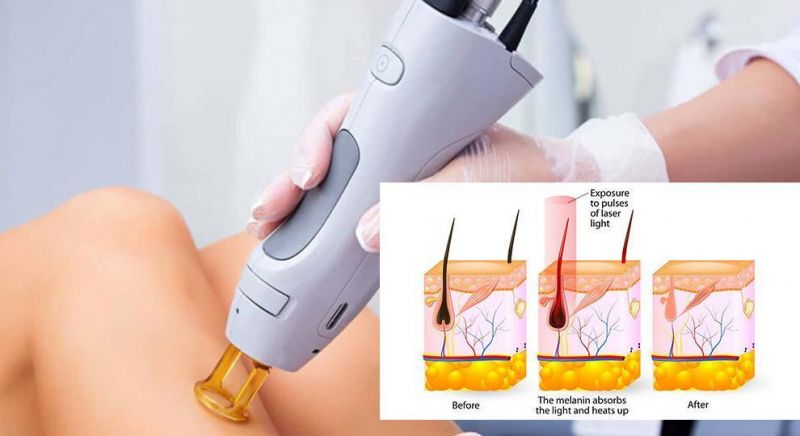 M-Hair Removal Skin Rejuvenation Pigmentation Treatment