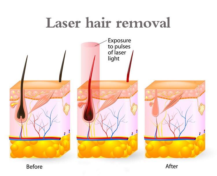 Diode Laser Hair Removal Machine for Depilaction Salon Equipment Price