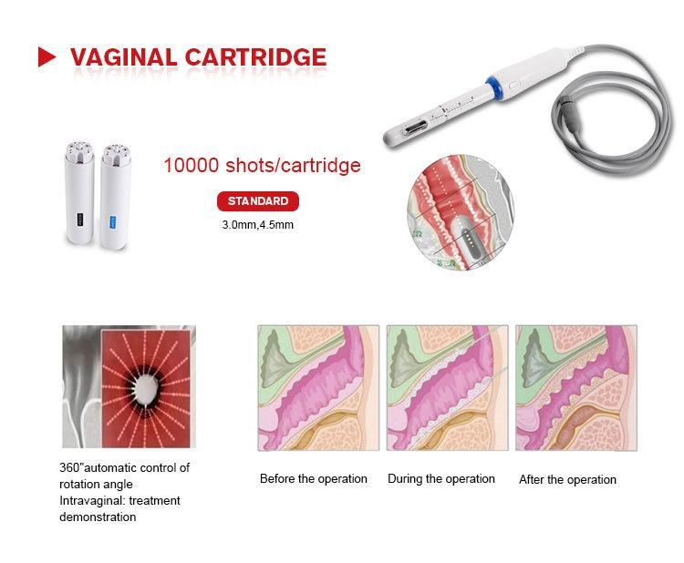 4D Ultrasound Hifu machine Smas Hifu High Intensity Focused Ultrasound