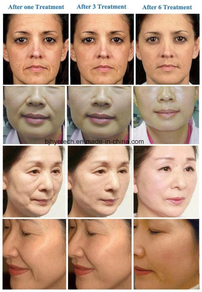 Korea V-Max Ultrasound Face Lift Machine Skin Care Skin Lifting Hifu