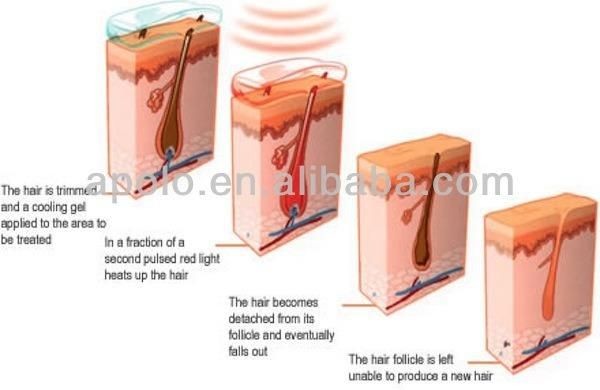 Reliable Supplier Medspa Use Apolomed HS-620 IPL Laser Hair Removal System