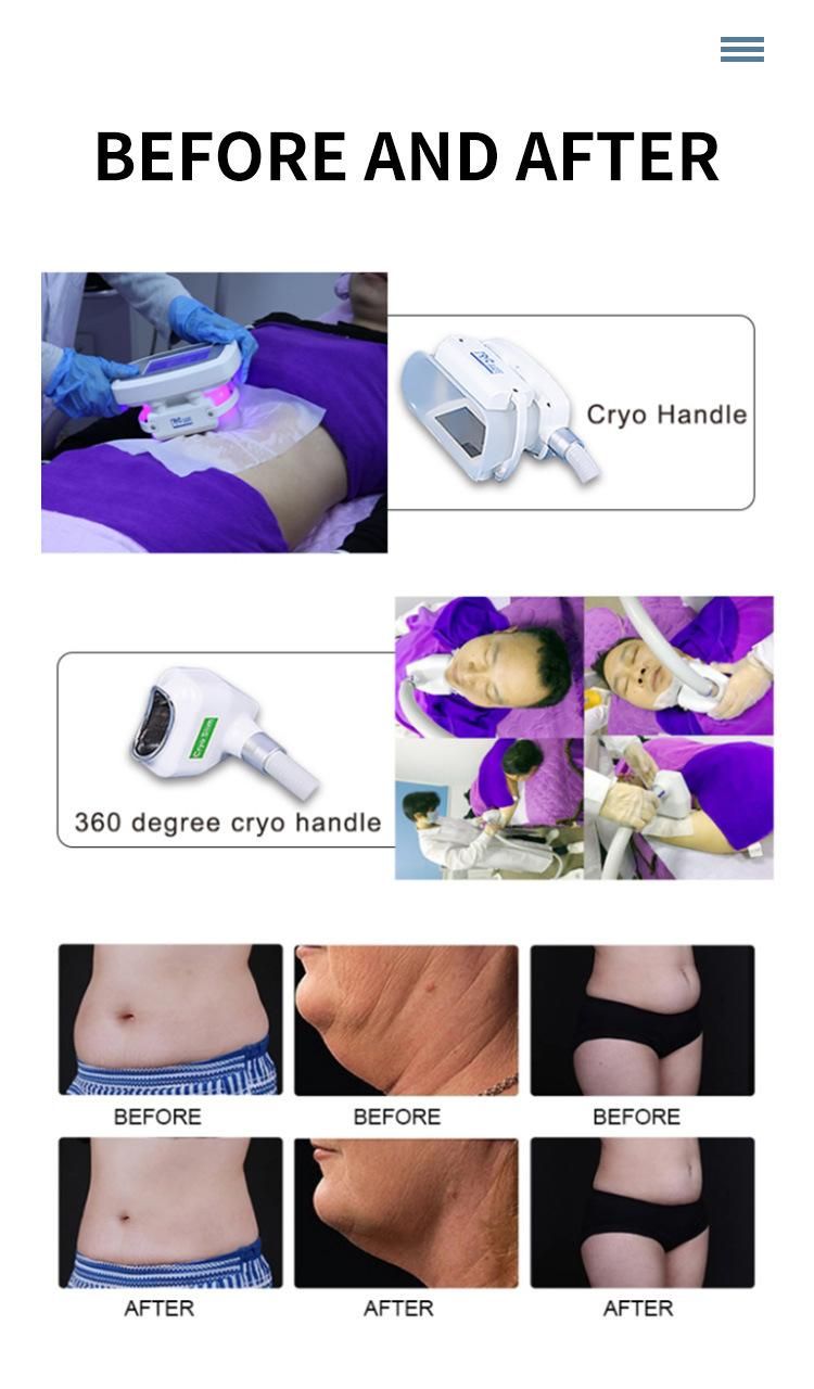 Cryolipolysis Body Slimming Machine Cryotherapy Device Vacuum Technology