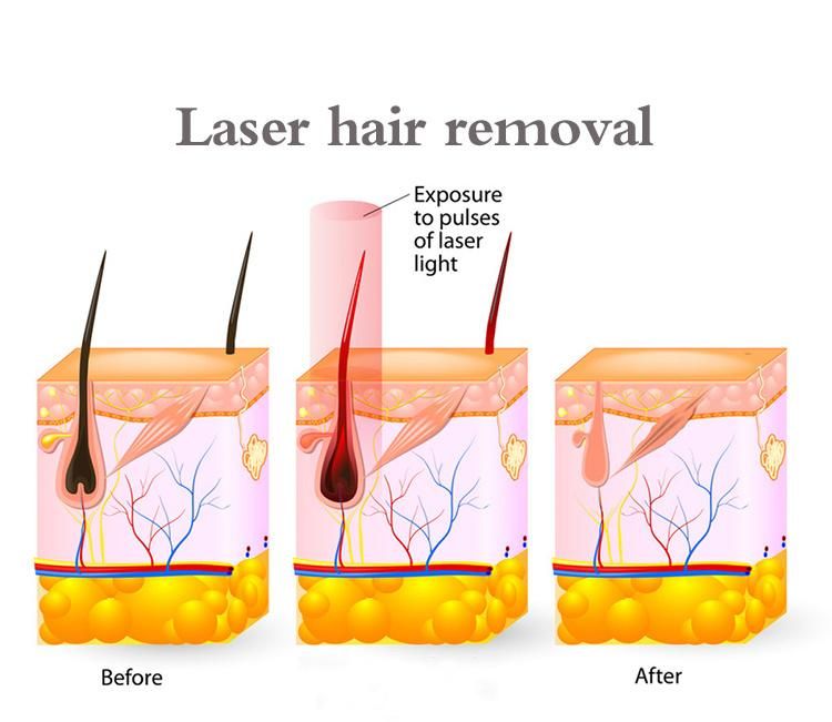 up-Rated Vertical Laser Machine Hair Removal 808nm Diode Laser Depilator