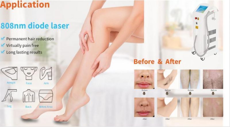 Sincoheren 2021 New Product 755 808 1064nm Diode Laser Beauty Equipment for Hair Removal