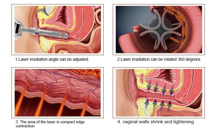 CO2 Fractional Laser Vaginal Rejuvenation Beauty Equipment for Skin Rejuvenation