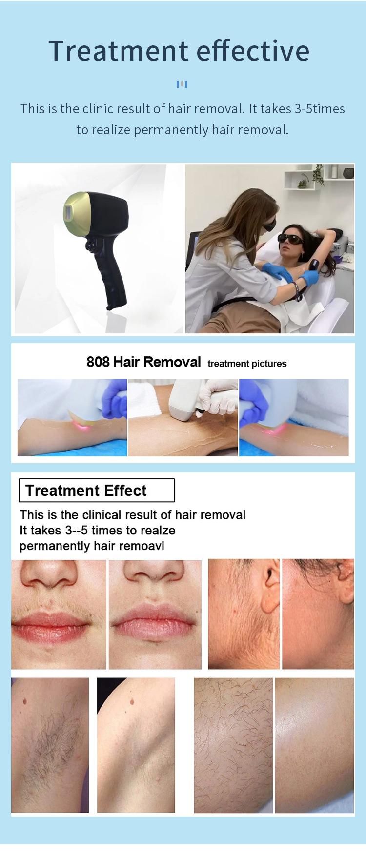 High Power Diode Laser Hair Removal 755/808/1064nm for All Skin Types