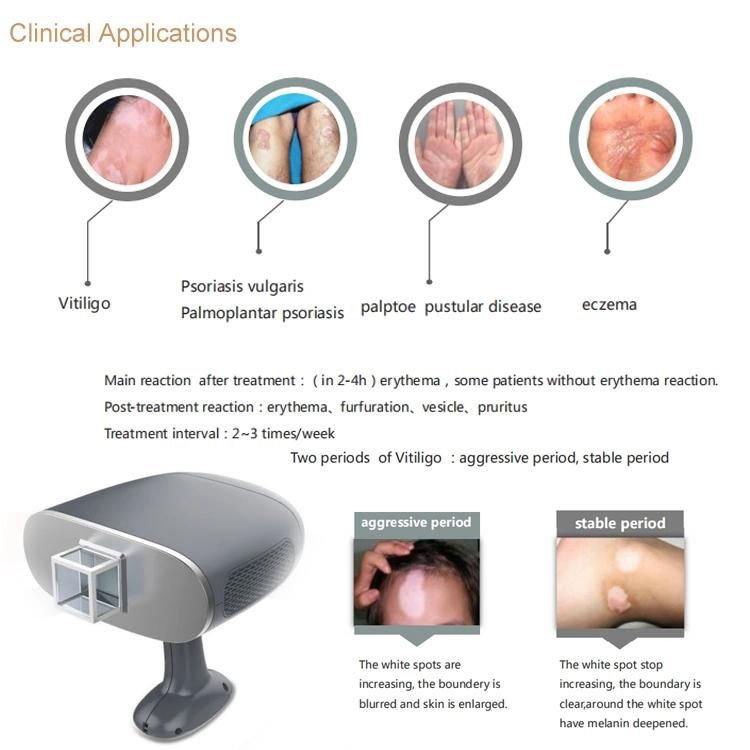 Peninsula Excimer Laser 308c Psoriasis Vitiligo Laser Machine