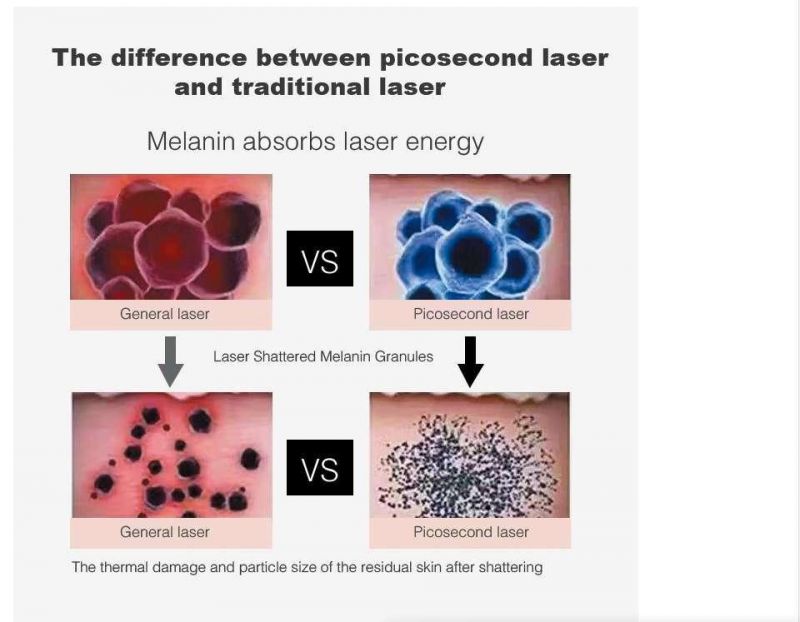 Pico Laser Machine for Factory Price to Tattoo Removal and Skin Rejuvenation