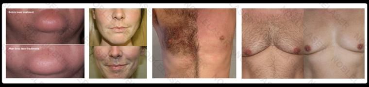 808nm Diode Laser Hair Removal with Big Spot