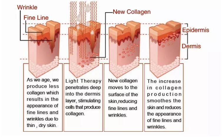 Beauty Machine Scar Removal Fractional Skin Resurfacing 1064nm ND YAG Laser Fotona 4D PRO Laser 4D Fotona Laser for Face Beauty Device Fotona Laser