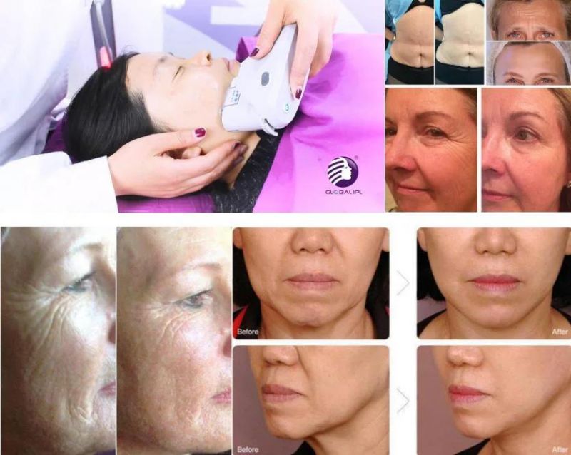 Portable Hifu Beauty Equipment for Face Lifting Wrinkle Removal