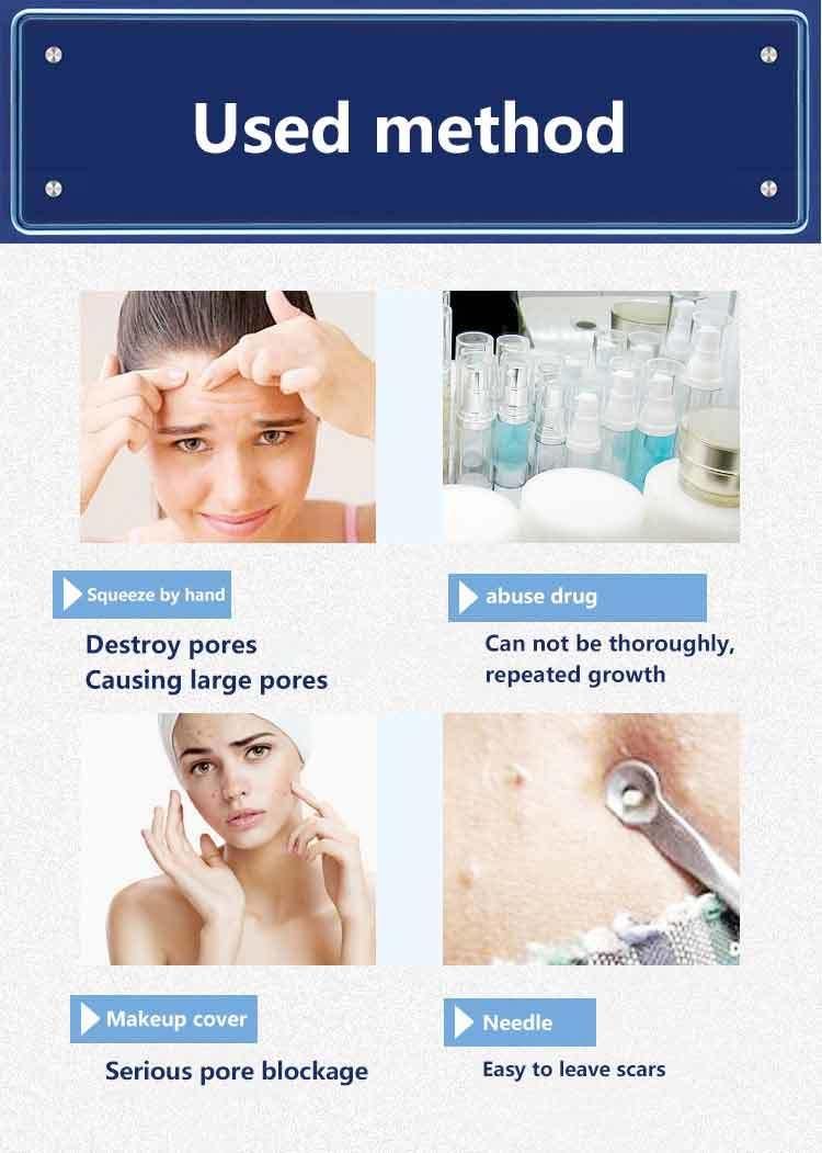 2019 Acne Removal Machine Body Acne Treatment