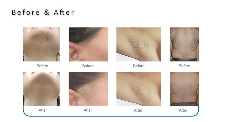 4 Wavelengths 755 808 940 1064 Diode Laser Hair Removal Machine Beauty Salon Equipment