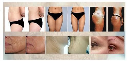 Fat Dissolving 40k Ultrasonic Cavitation Slimming Treatment