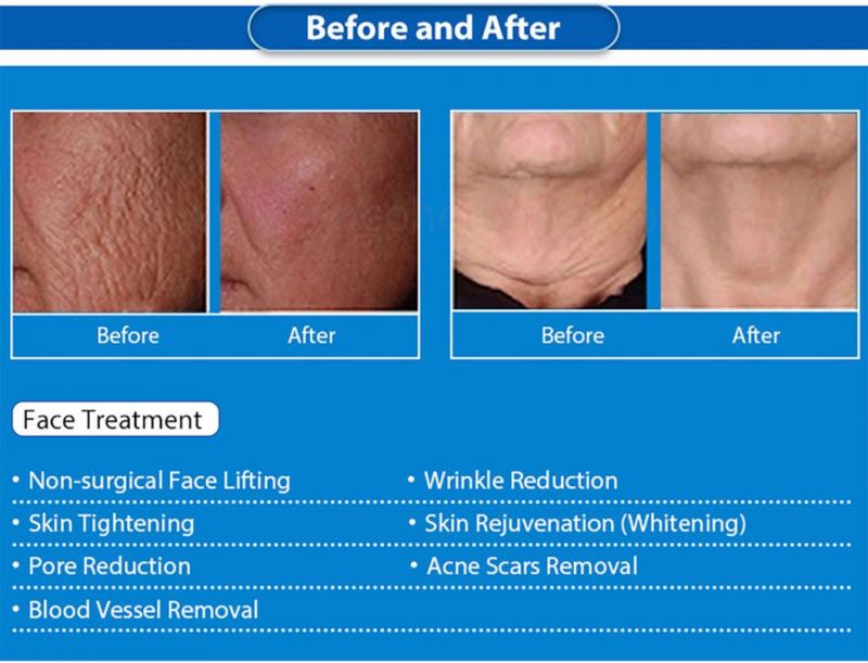 Stretch Scars Marks Remove Anti-Wrinkle Fractional RF Microneedle Machine