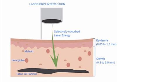 Laser Tattoo Removal and Skin Rejuvenation (US409)