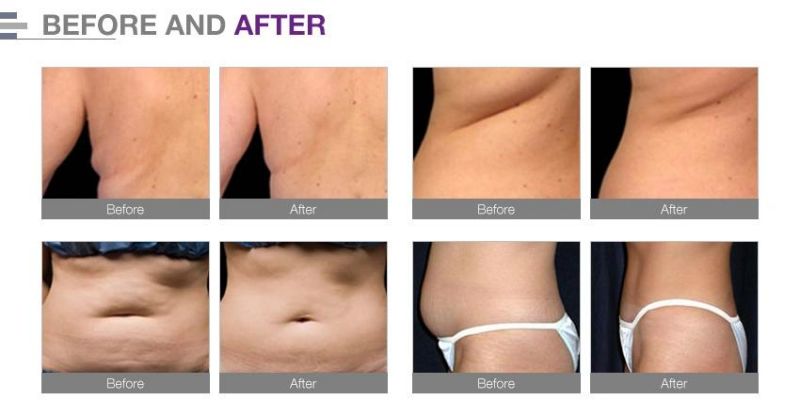 Best Professional Cellulite Reduction Lipo Laser Cryotherapy Fat Remove