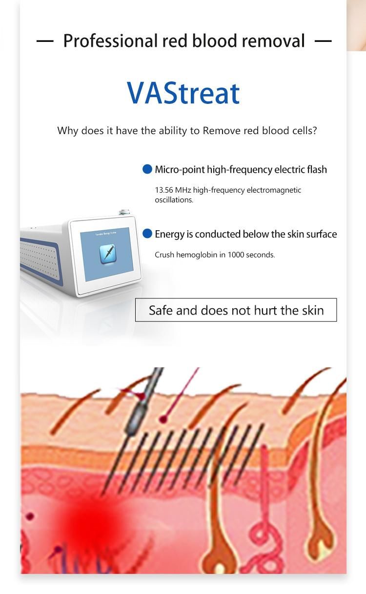 Vastreat RF High Frequency Vascular Removal Machine/Spider Vein Remove RF Equipment