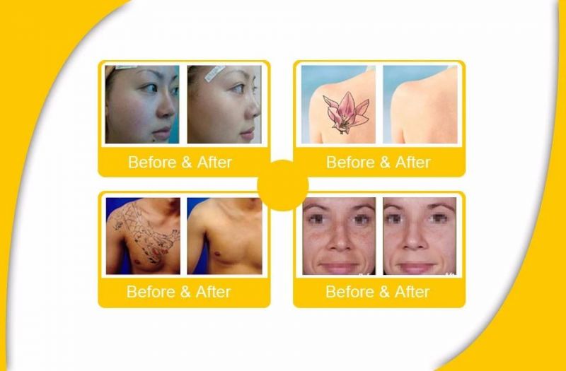 New Trend Skin Resurfacing Picosecond Technology Laser System Beauty Machine