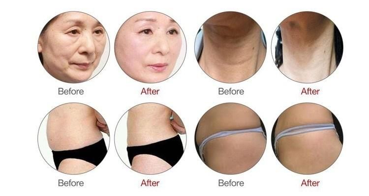 20000 Shots Anti-Wrinkle Hifu Face Lift Machine Intensity Skin Tightening 3D Beauty Machine