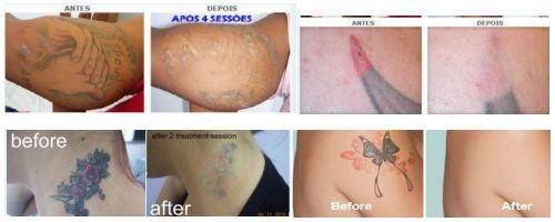 Effective Q Switch ND YAG Laser Skin Rejuvenation Tattoo Removal