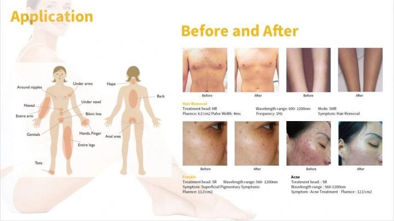 Consultant Be Best Selling FDA Medical CE Approved Face Hair Removal Cream IPL Laser Machine for Women
