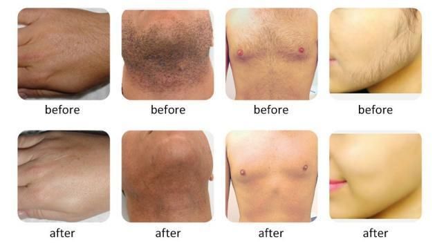 Medical CE Certificated Hair Removal Diode Laser